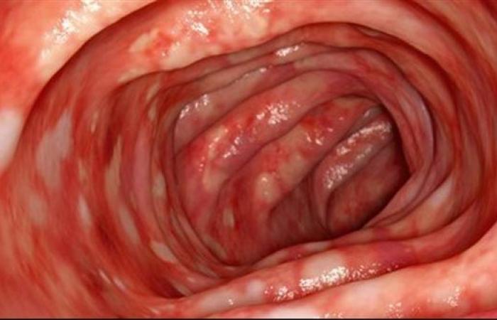 أعراض وأسباب إلتهاب القولون المجهري وأسباب الإصابة به