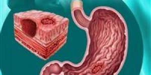 "وجع صامت يبدأ بحرقة خفيفة " قرحة المعدة وخطورتها وكيف يتم التعامل معها؟