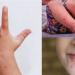استشاري
يكشف
أعراض
وأسباب
متلازمة
اليد
والقدم
والفم
عند
الأطفال