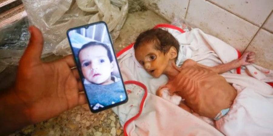 مدير مجمع الشفاء: سجلنا انتشار أوبئة تصعب مقاومتها لدى الأطفال بسبب سوء التغذية
