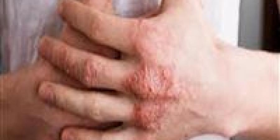 تعرف
      على
      أهم
      فوائد
      زيت
      جوز
      الهند
      لعلاج
      الإكزيما
      وطرق
      استخدامه
      الصحيحة