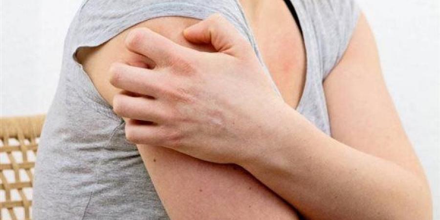 أسباب
      وأعراض
      إلتهاب
      الغدد
      العرقية
      القيحي
      وطرق
      العلاج
      والوقاية